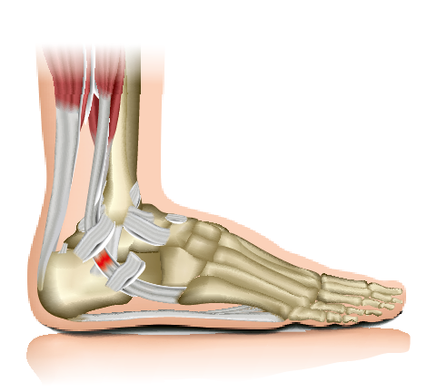 Illustration of Plantar Fasciitis, a condition characterized by degeneration of the plantar fascia, leading to heel pain